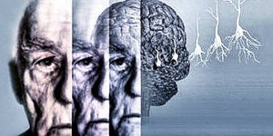 Ознаки хвороби Альцгеймера