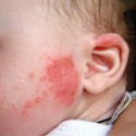 Як вилікувати у дитини алергію